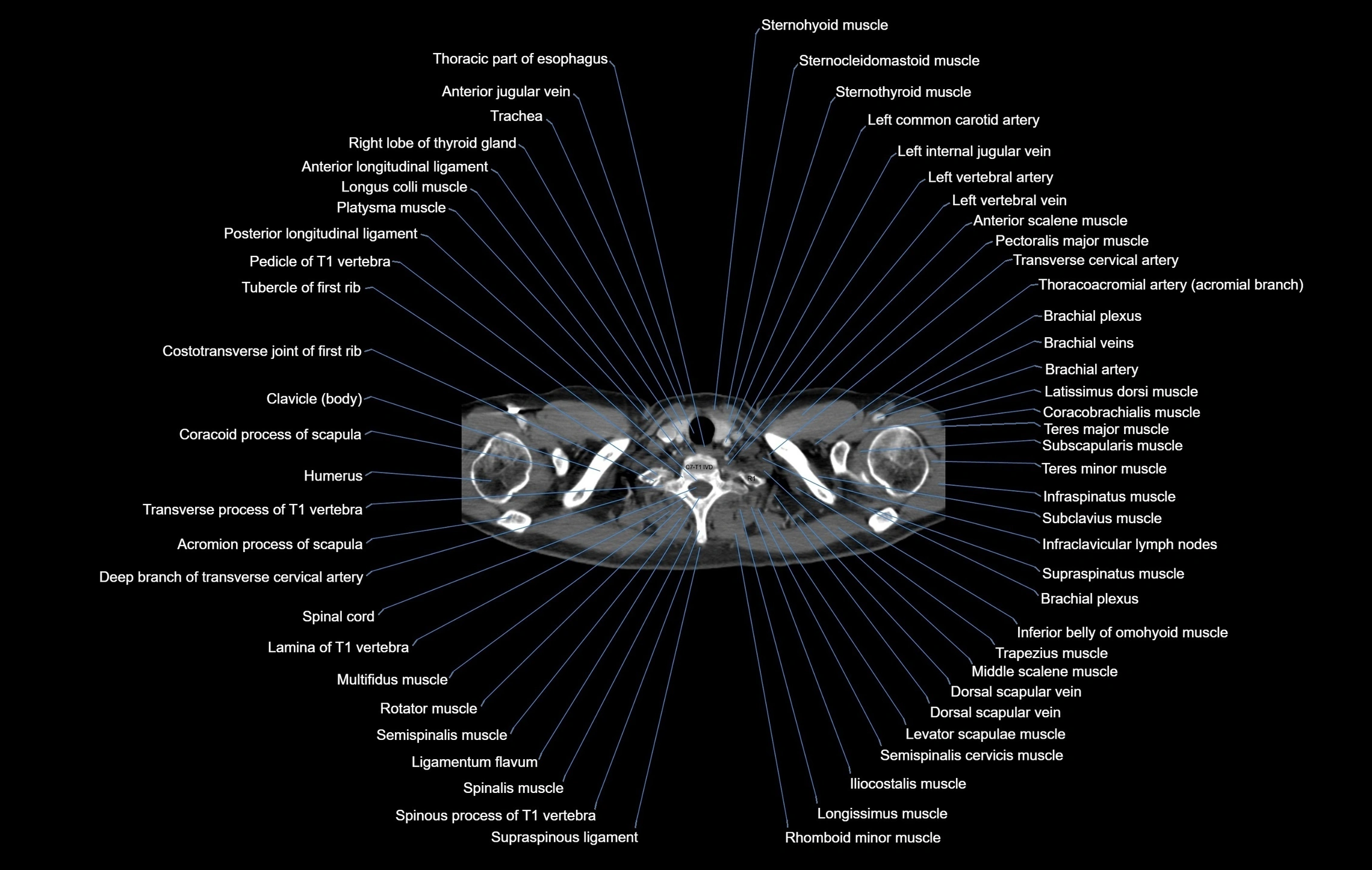 CT chest (thorax) soft tissue window labelled axial cross sectional anatomy radiology image-00002.webp